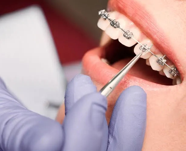 Braces Specialist